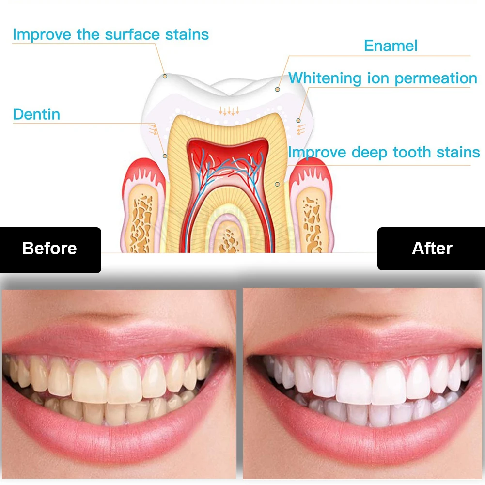 Dental Teeth Whitening Kit Min - đánh giá và giá Teeth Whitening Accelerator