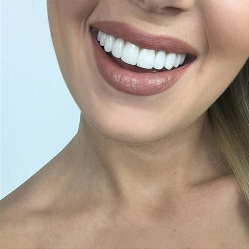 Whitening Teeth Veneers Tempor - đánh giá và giá Teeth Whitening With Braces