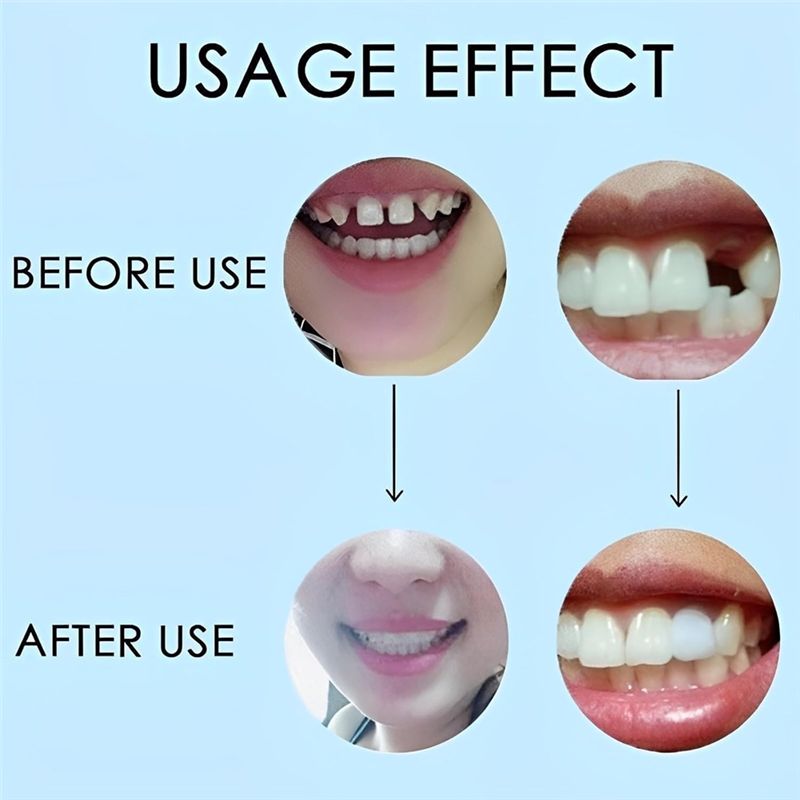[NEW!ABMK】 2 Pairs,Regain Beau - đánh giá và giá Teeth Whitening With Braces